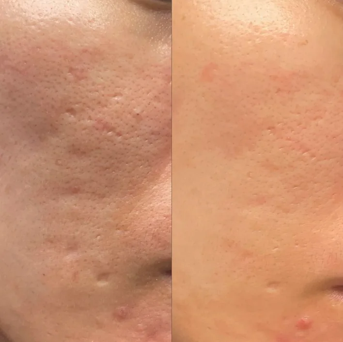 Før og etter microneedling